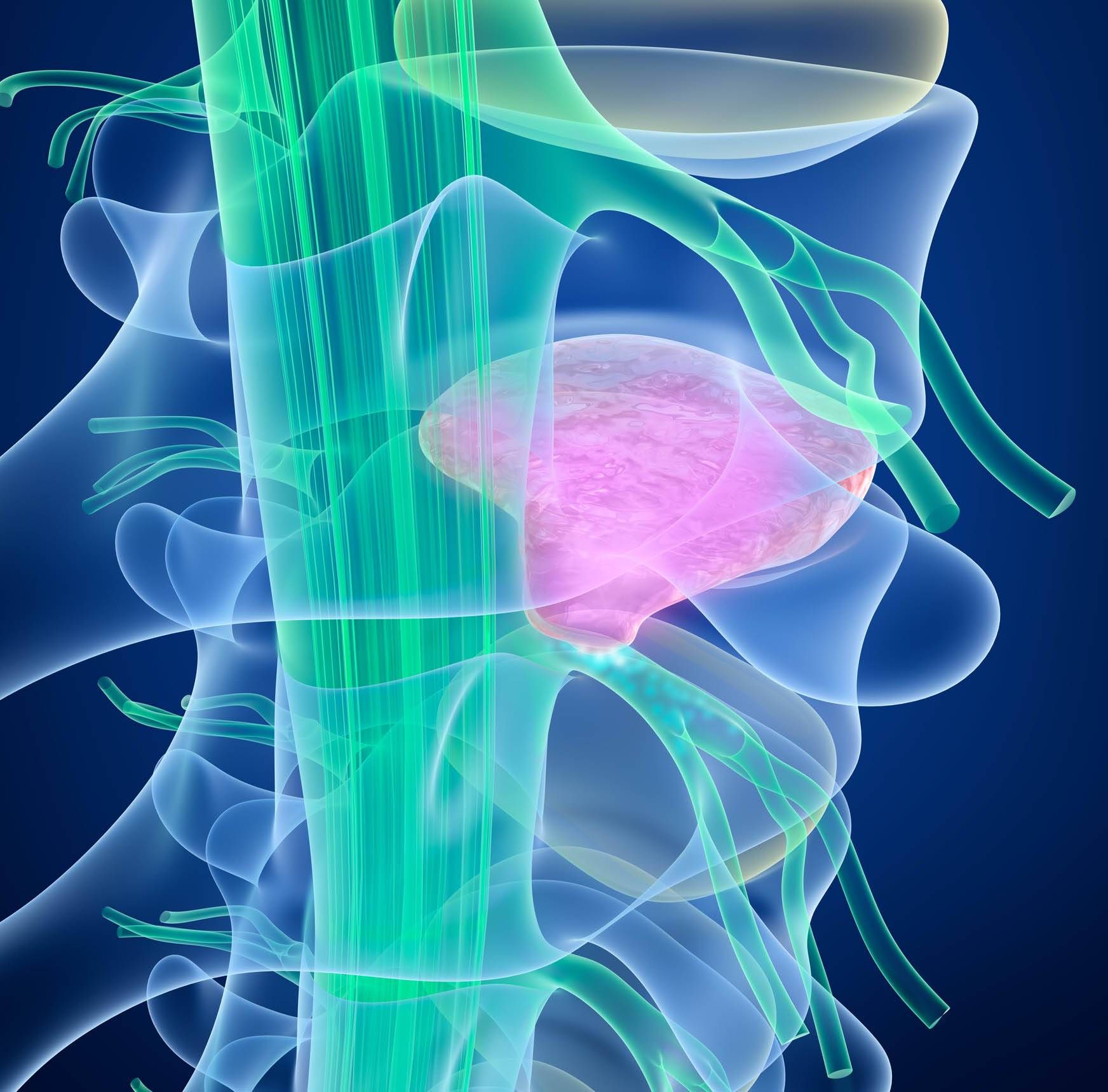 Spinal cord under pressure of bulging disc, 3D illustration