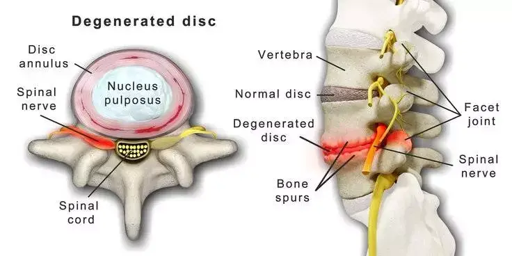 large_spine_degenerative_disc_disease_01
